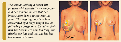 Breast reduction surgery results