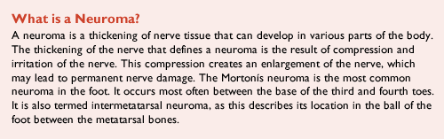 What is a neuroma?