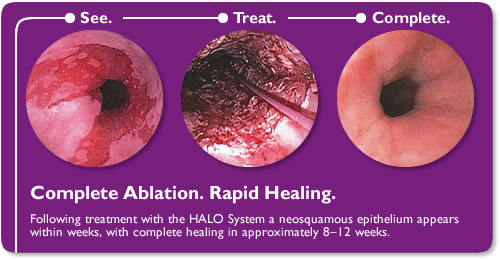 Ablation Treatment for Barrett's Esophagus