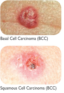 Basal Cell Carcinoma (BCC) and Squamous Cell Carcinoma (SCC)