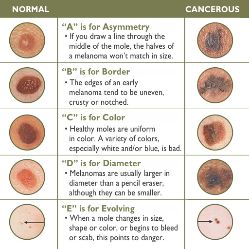Healthy Viewpoints–early Signs Of Skin Cancer