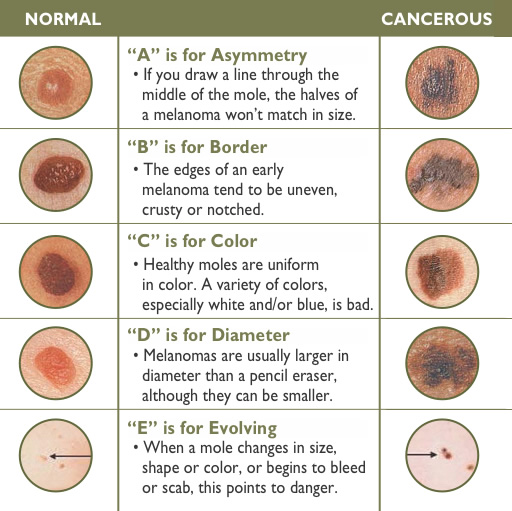 Skin Cancer Chart Pictures