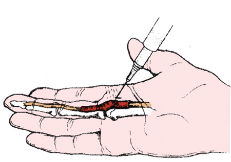 trigger_finger_diagram