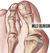 bunion