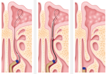 Sinuplasty Insertion