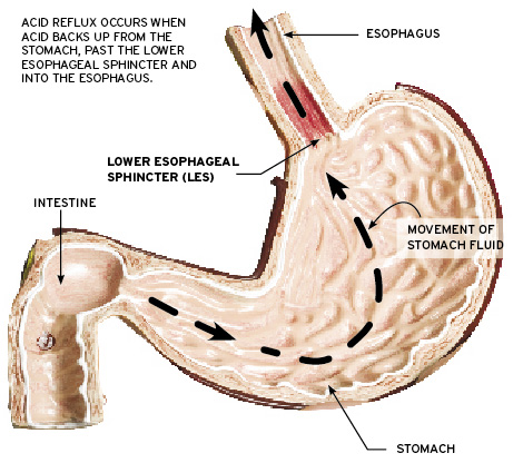 esophageal_sphincter