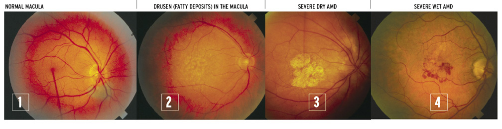 macular