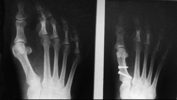 Bunion Xray