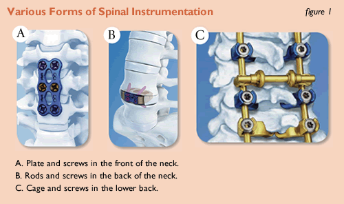 Various forms of spinal instrumentation