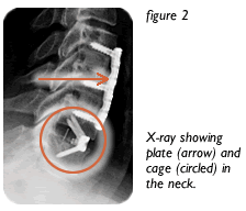 X-ray of plate and cage in the neck.