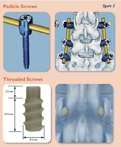Pedicle and Threaded Screws