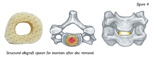 Structural allograft spacer for insertion after disc removal.