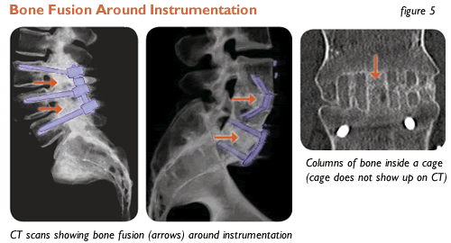 Bone fusion around instrumentation.