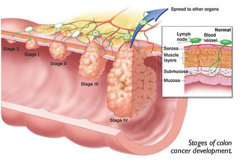 Stages of Colon Cancer