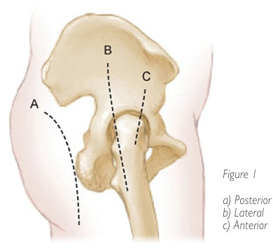 Hip Replacement Figure 1a, 1b, 1c