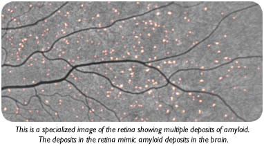 Specialized picture of etinal amyloid
