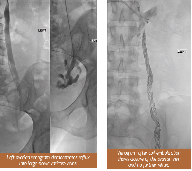 Healthy Viewpoints: Pelvic Congestion Syndrome